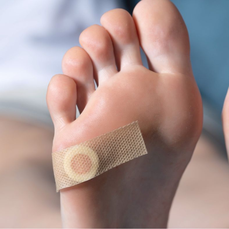 Plantar Warts: What Are They and How Can Verrutop Help?