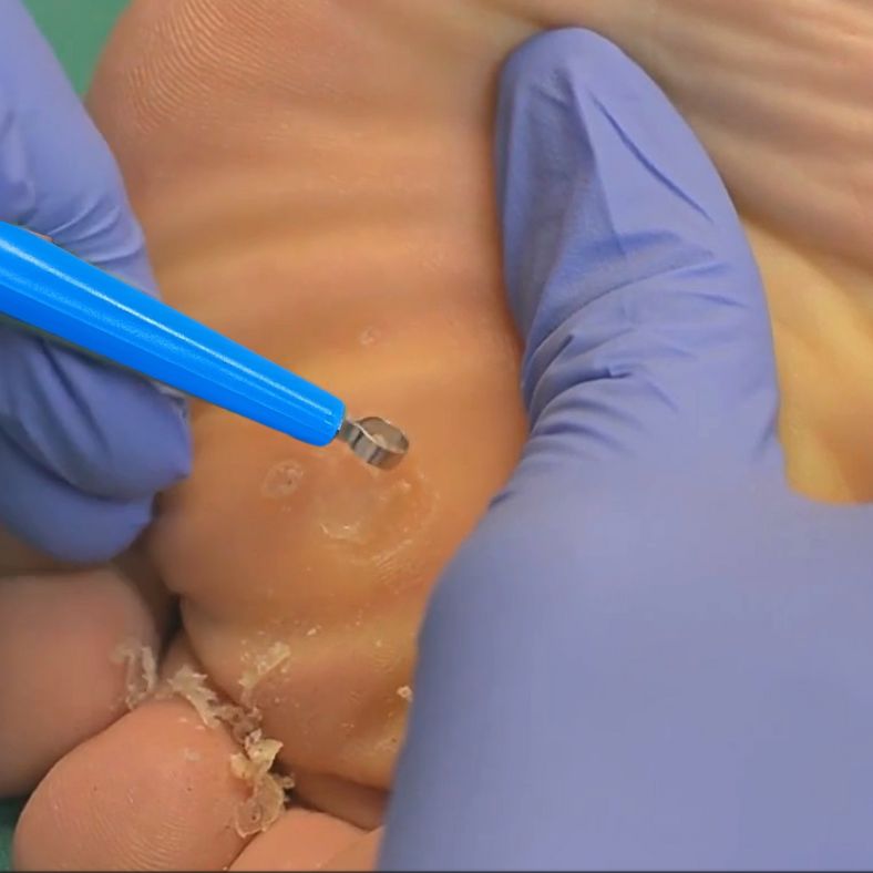 Using Dermal Curette with Verrutop Treatment